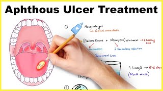 Aphthous ulcer stomatitis Canker sore treatment [upl. by Estella858]