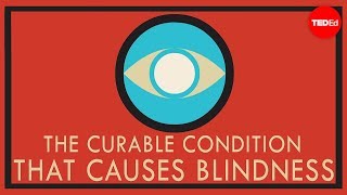 A curable condition that causes blindness  Andrew Bastawrous [upl. by Nairehs277]