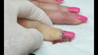 Worst Nail Infections of All Time Paronychia [upl. by Upshaw689]