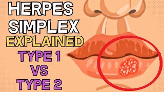 Herpes Simplex  Type 1 vs Type 2  EXPLAINED IN 2 MINUTES [upl. by Steven]