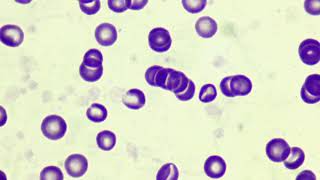 Rouleaux formation in blood smear [upl. by Coray453]