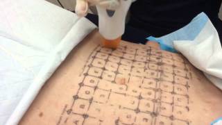 Thermage Treatment of the Abdomen  Dr Michael Kaminer [upl. by Hermes]