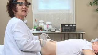 Electrolysis Buttocks Hair Removal Treatment [upl. by Pratte]