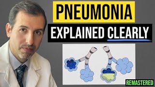 Pneumonia Explained Symptoms Diagnosis Labs Treatment [upl. by Attwood]