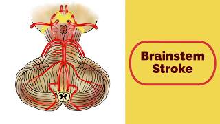 Brainstem Stroke Syndromes [upl. by Christmas707]