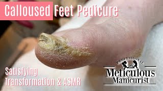 How to Pedicure Extremely Calloused Feet and Toes ASMR [upl. by Laicram]