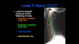 Radiology of Spine Trauma [upl. by Arel653]