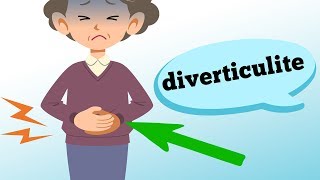 O que é DIVERTICULITE e quais os sintomas [upl. by Sitruk144]