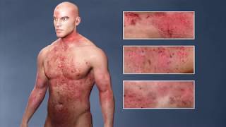 Atopic Dermatitis eczema From the Inside Out [upl. by Supple741]