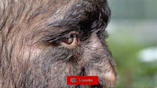 Hypertrichosis What is Werewolf Disease [upl. by Aneahs559]