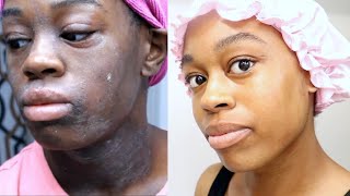 Eczema Treatment Journey  This Skincare Routine Changed My Life  DeSade [upl. by Hserus972]