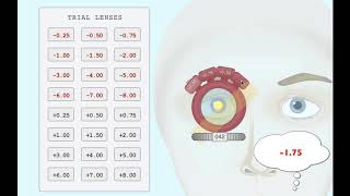 Retinoscopy with trial lenses Minus cylinder [upl. by Swee191]