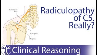 Suprascapular Nerve Entrapment mimicking C5 Radiculopathy [upl. by Aveneg184]