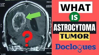 What is Astrocytoma Tumor [upl. by Alie]