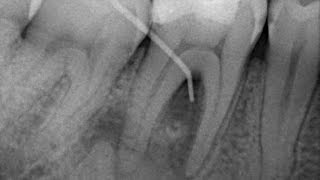 Endodoncia en Molar Inferior [upl. by Milman]