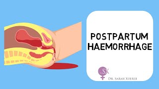 Postpartum Haemorrhage [upl. by Tawney]