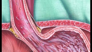 Barrett’s Esophagus Screening [upl. by Alesi73]