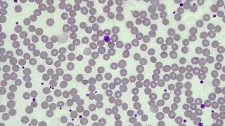 WBC Differential WBCPLT Estimate RBC Morphology [upl. by Annai]