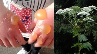 Giant Hogweed  A FleshBurning Plant Explained [upl. by Korenblat646]