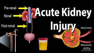 Acute Kidney Injury aka Acute Renal Failure Animation [upl. by Jolyn651]