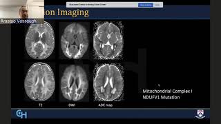 Radiological Diagnosis and Approach to Leukodystrophies [upl. by Ardnas]