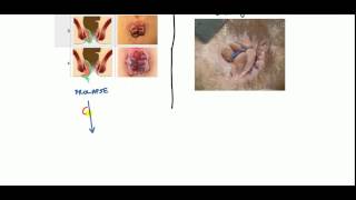 Hemorrhoids Lecture for USMLE [upl. by Hales408]