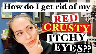 Blepharitis  2 Easy steps to banish red crusty itchy eyes  The Eye Surgeon [upl. by Indyc]