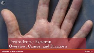 Dyshidrotic Eczema  Overview Causes and Diagnosis [upl. by Leamiba643]