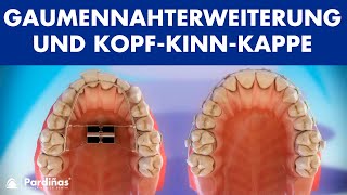 Kieferorthopädie  Gaumennahterweiterung und KopfKinnKappe © [upl. by Eidak]