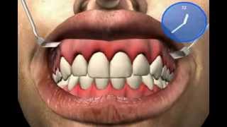 Why Gums bleed  Gingivitis [upl. by Arsuy]