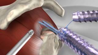 Knotless Rotator Cuff Repair with Arthrex® SpeedFix™ [upl. by Akena]